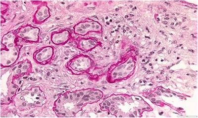 Two sides of the same coin: a complex presentation of autosomal dominant tubulointerstitial kidney diseases: a literature review and case reports